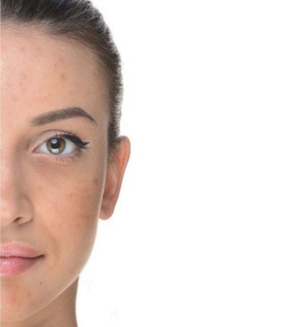 Before-Manchas y Acné