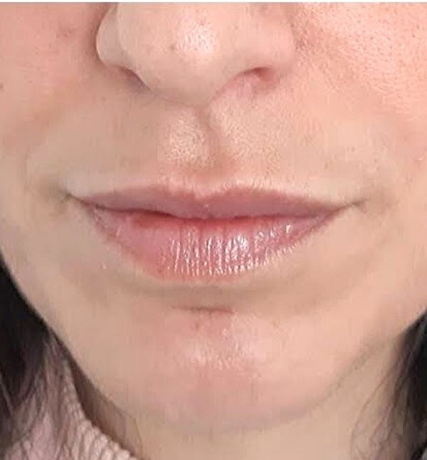 After-Remodelación Labios